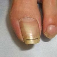 wound_nail_img (2)