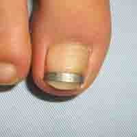 wound_nail_img (3)